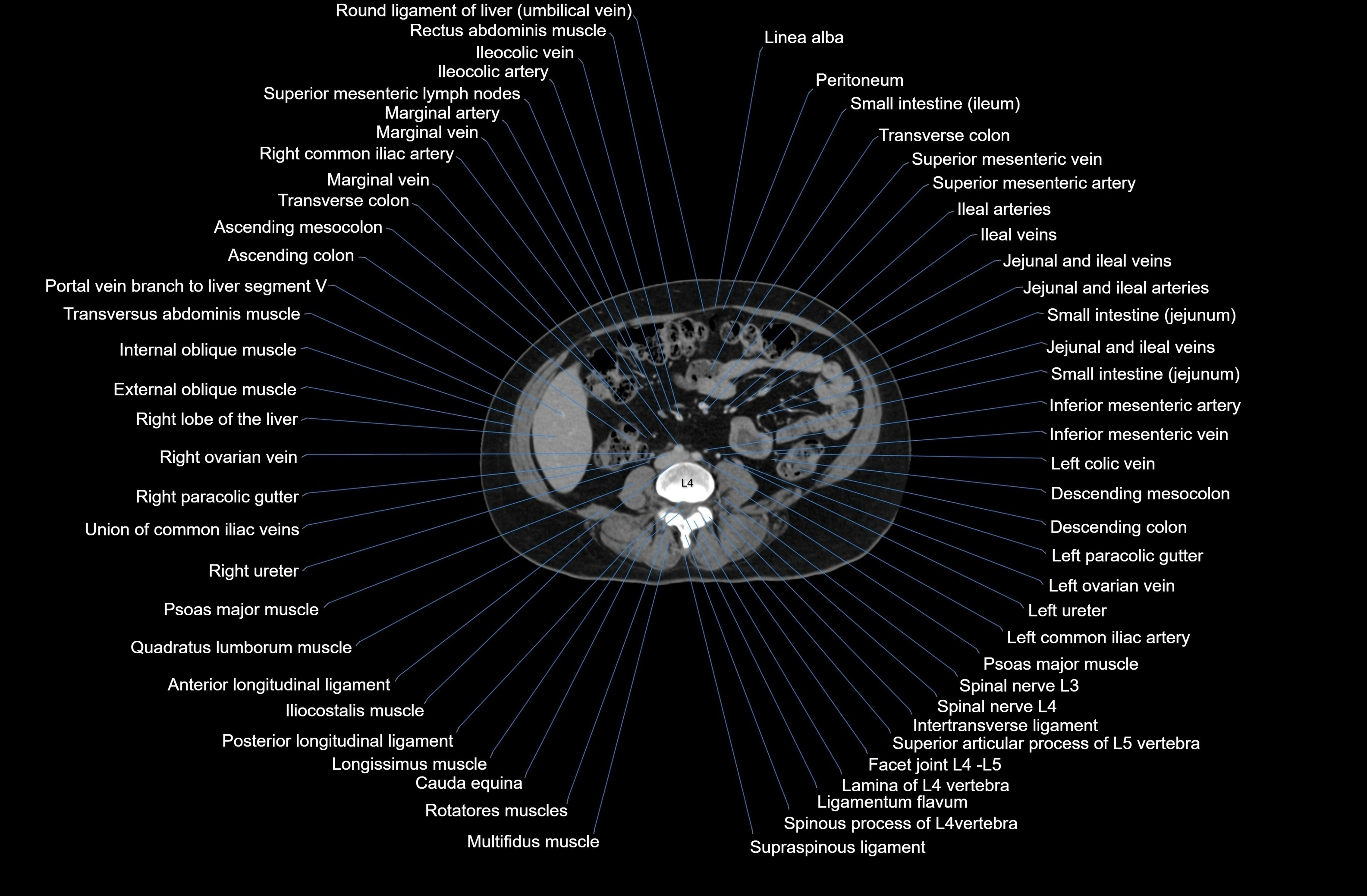 CT Abdomen axial cross sectional anatomy labelled radiology image-00053.webp
